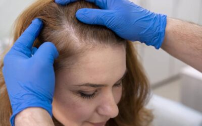 Tipos de alopecia: Qué Tipos de Caída del Cabello Hay y Tratamientos