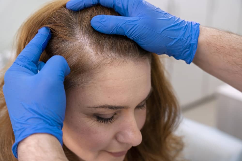 Tipos de alopecia: Qué Tipos de Caída del Cabello Hay y Tratamientos