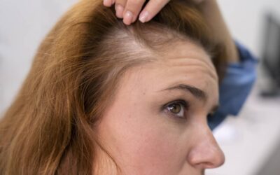 Alopecia en mujeres: ¿Qué es la alopecia en la mujer y qué causa la caída del cabello?