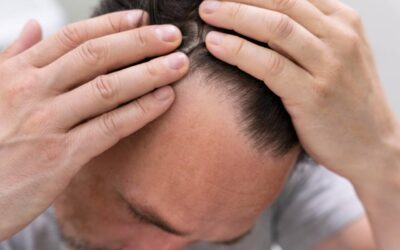 Alopecia cicatricial: diagnóstico y opciones de tratamiento capilar