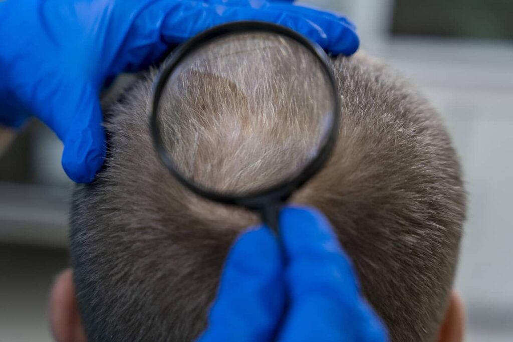 Alopecia areata